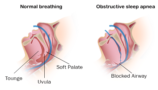 Sleep Apnea: A Comprehensive Guide To Diagnosing, Treating and Understanding the Condition