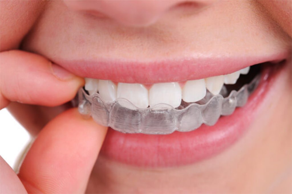 6 Best Mouth Guards for Teeth Grinding to Help Treat Sleep Bruxism