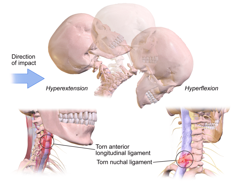 How to Sleep with Whiplash: 5 Methods that Will Improve Your Rest