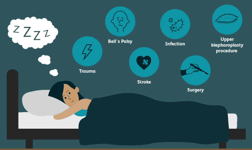 How to Sleep with Your Eyes Open in 6 Steps