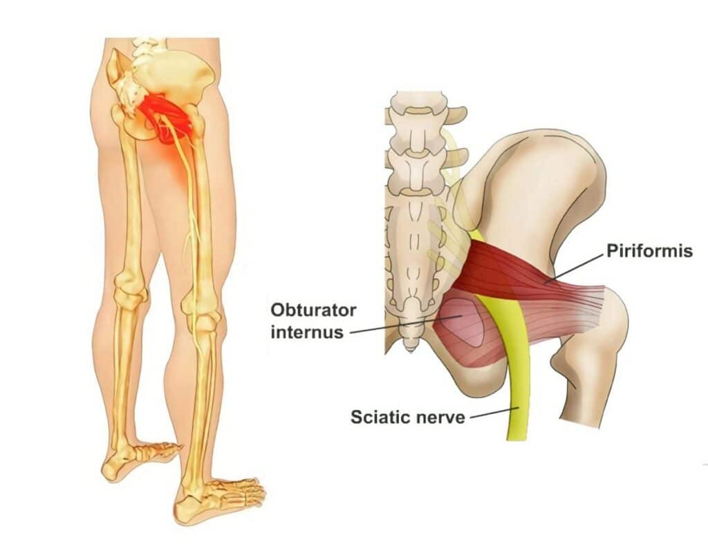 How to Sleep with Piriformis Syndrome: Useful Advice