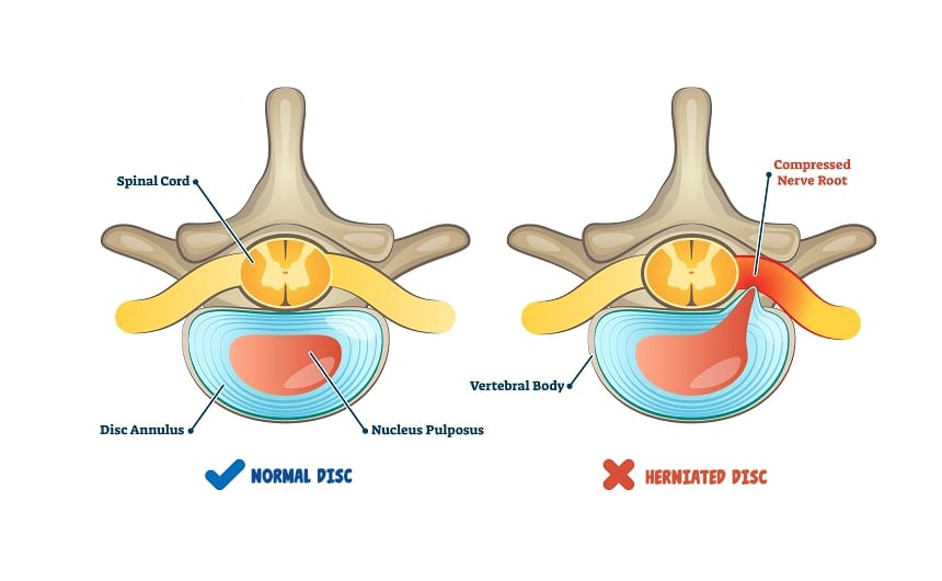 6 Best Mattresses for Herniated Disc: Relieve Your Pain at Night