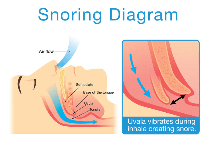 How to Stop Someone from Snoring. Tips and Tricks from an Expert.